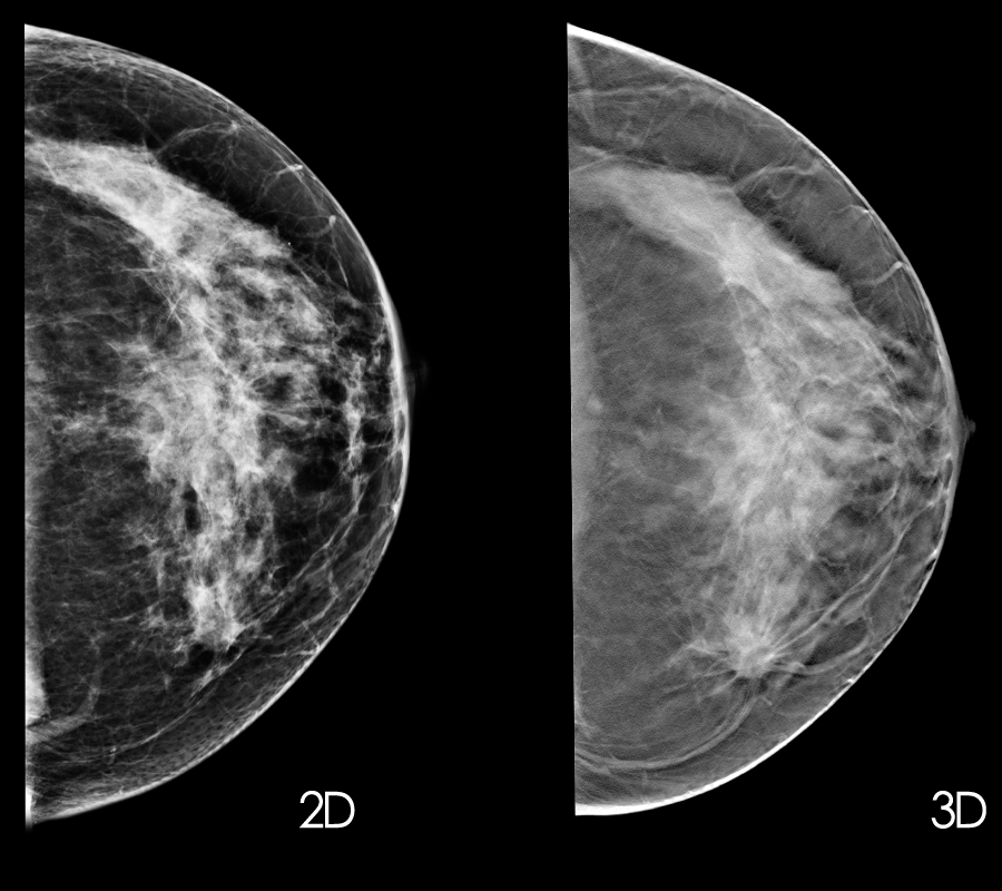 New Guidelines Mammograms Should Start At 50