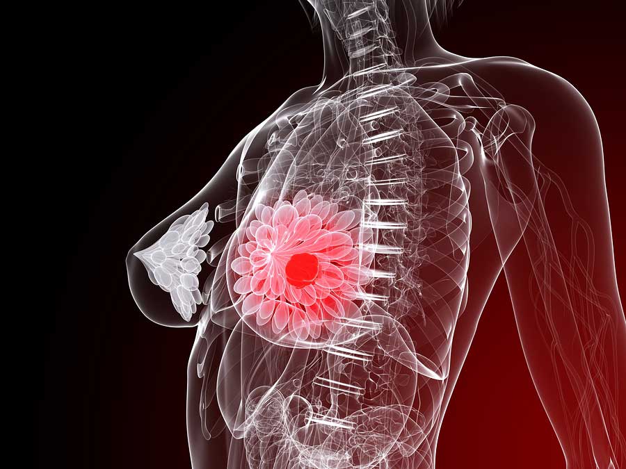 Blood Test Can Identify Breast Cancer Relapse Study Says