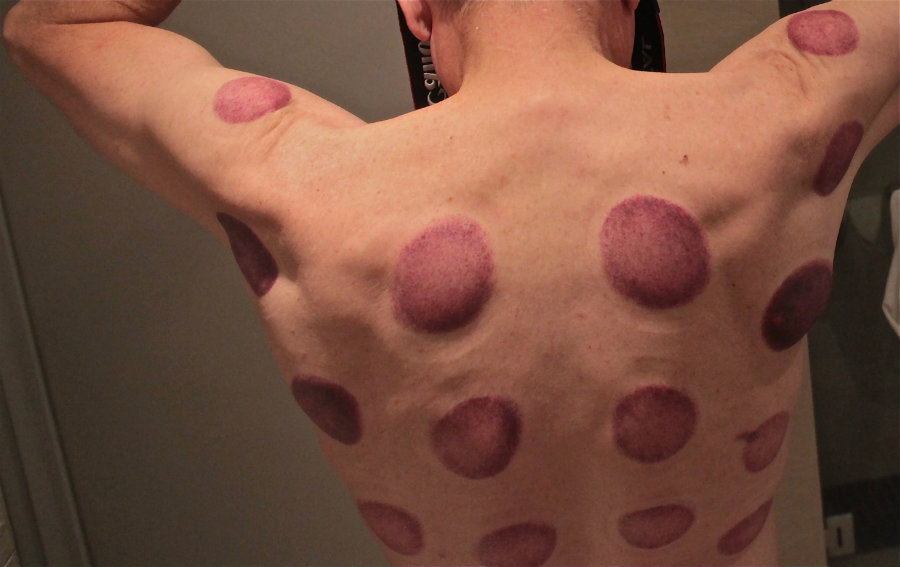 It is important to understand that cupping must be executed by professionals because it can bring damages to the skin and muscles if it is not. Photo credit: Turn There WordPress