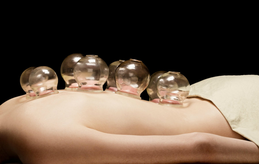 Cupping is an alternative form of pain relief through which a flexible cup is placed on the skin on sore muscles, and sucks the skin up into the cup.  Photo credit: Wild Woods Yoga & Wellness