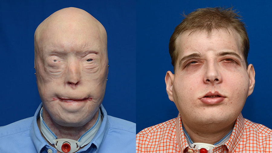 patrick-hardison-face-transplant