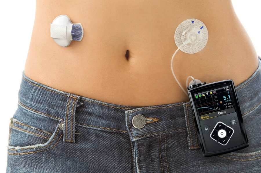 Medtronic's newest diabetes monitor is the MiniMed 670G, a tracking device that checks on the patient's blood sugar levels every five minutes. Photo credit: Newsweek