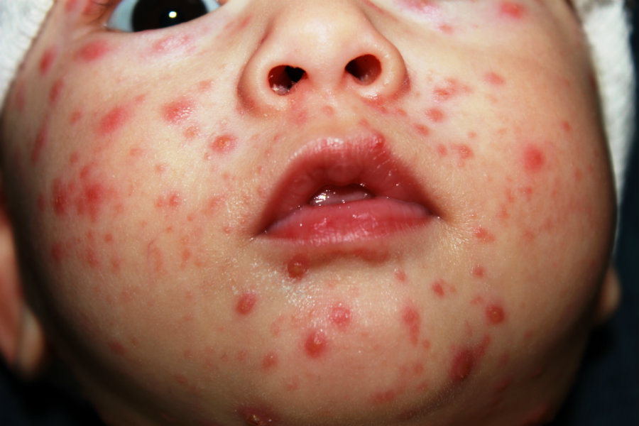 The most significant decrease has been among children aged 5 to 14, who are most likely to have received the 2-dose varicella vaccine. Photo credit: wikimedia Commons