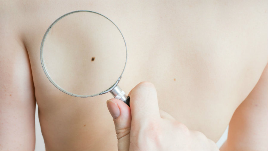 Melanoma cases have been dropping in the northern region of the United States. Photo credit: Vchalup / Fotolia  / Empowher