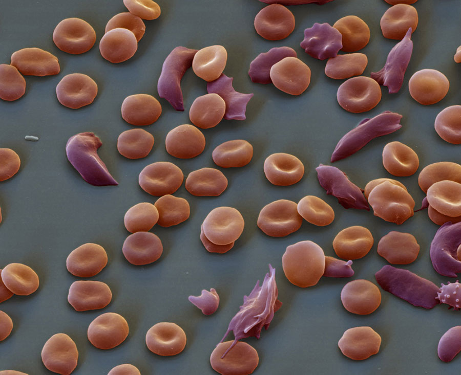 Doctors Discover A Cure For The Sickle Cell Anemia