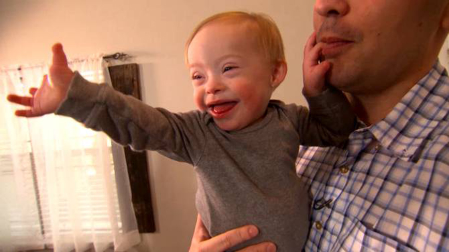 Gerber use a child with Down Syndrome as its image, Down baby Lucas Warren as Gerber Spokesbaby